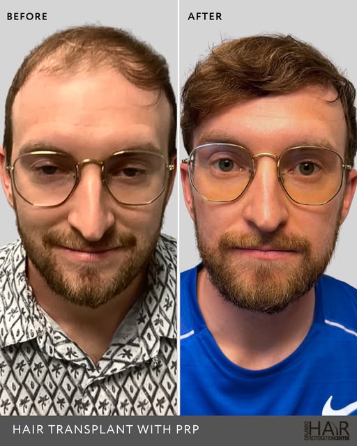 More than a hair transplant. A renewed sense of confidence. 🤍

Hair loss can change the way you see