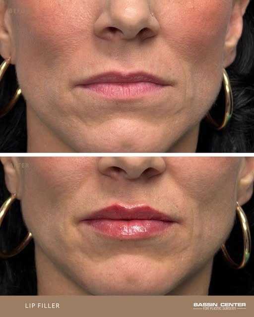 ✨ A little volume. A beautiful difference.

Lip filler can enhance the natural shape of the lips, re