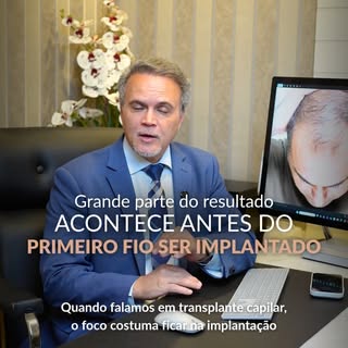 O segredo de um transplante capilar natural não está apenas na implantação, mas na estratégia que a 