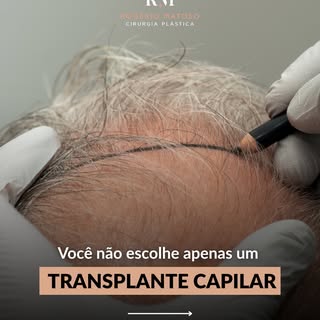 O transplante capilar é um investimento definitivo na sua identidade. 🏛️

Diferente de intervenções