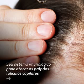 Seu sistema imunológico pode estar por trás da sua queda de cabelo. ⚠️

Em algumas doenças autoimune