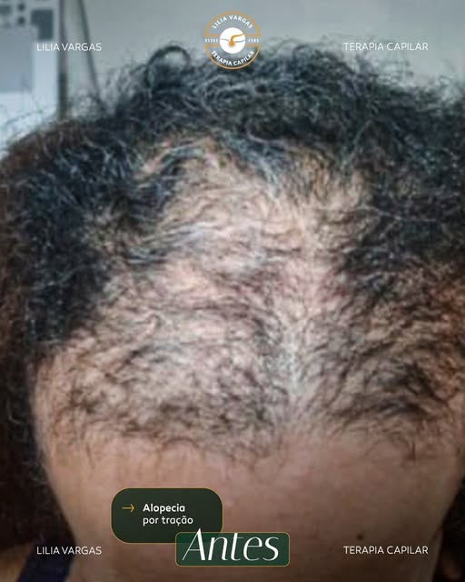 Este é o acompanhamento de uma cliente com alopecia por tração, quadro que pode estar relacionado ta