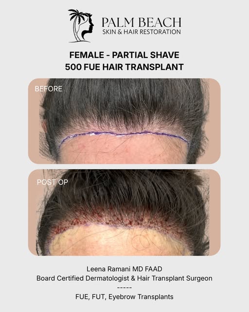 Designing a female hairline is an art form — softer, more irregular, with delicate curvature at the 