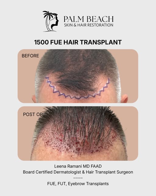 New hairline loading 🔄

That’s what an FUE hair transplant case looks like from start to finish. Ev
