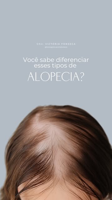 Queda de cabelo não é tudo igual, e entender o que está acontecendo faz toda diferença no tratamento