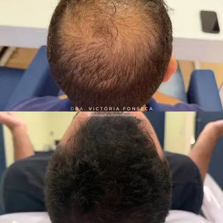 Tem resultado que a gente olha e lembra exatamente de onde começou. 🤍

Aos poucos, o cabelo foi res