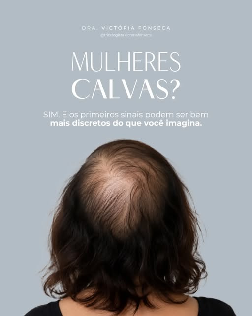 Nem toda mulher que percebe o cabelo mais fino está desenvolvendo calvície, mas toda mudança no padr