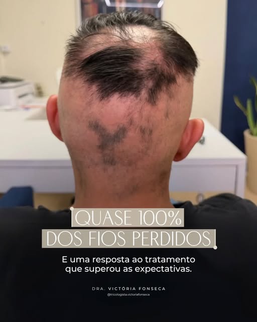 Alguns casos mostram que o tratamento capilar vai muito além do crescimento dos fios.

O caso do Gle