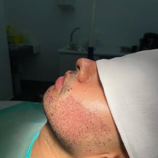 Un injerto de barba es un procedimiento médico de transplante capilar en el que se implantan los fol
