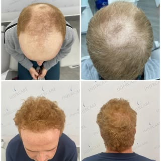 Resultados 12 meses tras la cirugía. Paciente de Jaén que sufría una alopecia androgenética de grado