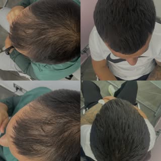 Resultado de tratamiento sin cirugía

- Recupera tu cabello

- Tratamiento adaptado al paciente 

- 