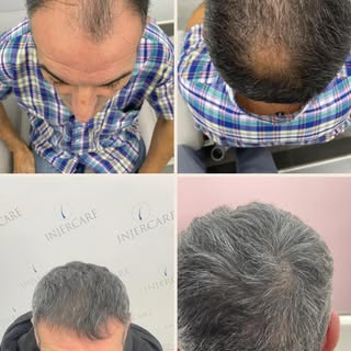 Paciente con alopecia androgenética  grado IV con vertex.
Resultados 1 año después de la cirugía 

-