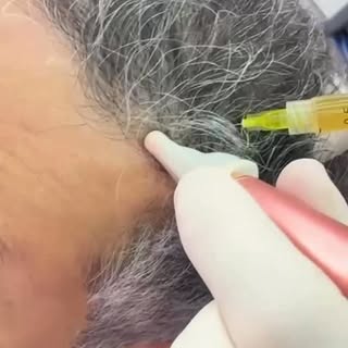 Fortalece tu pelo con plasma en tan solo una sesión en #injercare