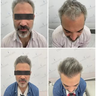 Injerto capilar resultado a los 12 meses tras la cirugía.

- Resultados naturales 

- Maximo volumen