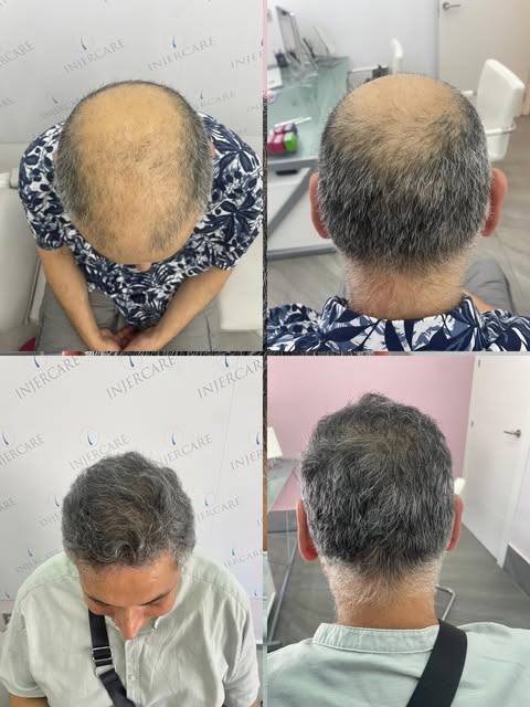 Resultados después de 1 año de la cirugía ✨

- Alopecia Androgenética grado VI

- Paciente de Sevill