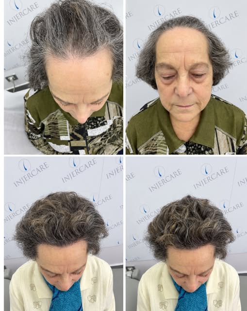 La alopecia femenina también tiene solución! ✨ 
Y sin Rapar!! 
En este caso la paciente sufría de al