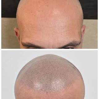 Un gran cambio con la micropigmentación capilar 3D. 

Pasa de la calvície a un look rapado. Con un f