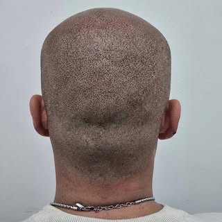 Efecte rapat. Millora discreta i imperceptible.
Si vols passar de la calvície a un look rapat, conta