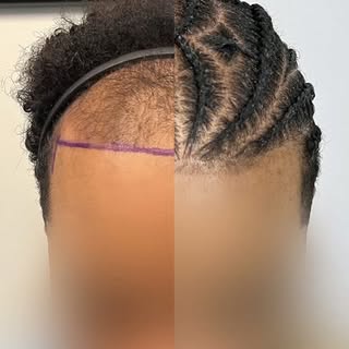 This is what results from a 3,201 graft FUT procedure can look like. These photos are taken roughly 