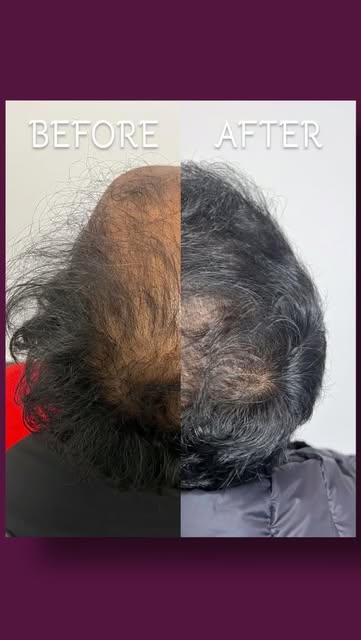 Our 31 year old male patient wanted to address the front half of the scalp and add density to create
