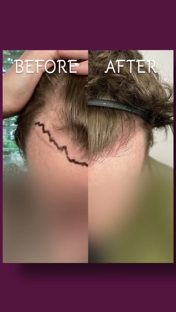 2,741 graft FUT transplant, 3 sessions of PRP, oral minoxidil and oral finasteride helped this 39 ye