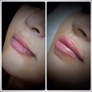 Lip fillers transformations ! 
#Lipfillers #fillers #Fillerlips 
Not all lip fillers make duck lips 