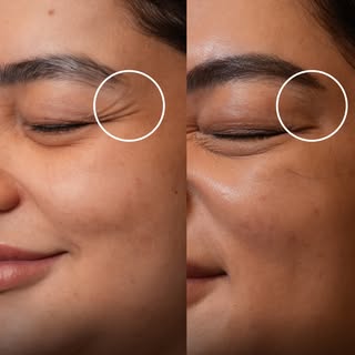 Botox can help soften the appearance of fine lines and crow’s feet by relaxing the muscles that crea