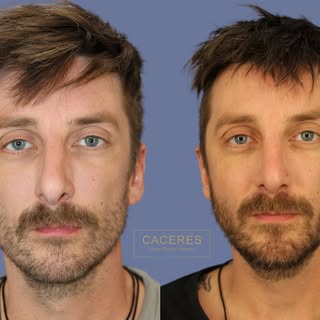 Another happy patient after functional + cosmetic rhinoplasty. 🙏

This case required both precision