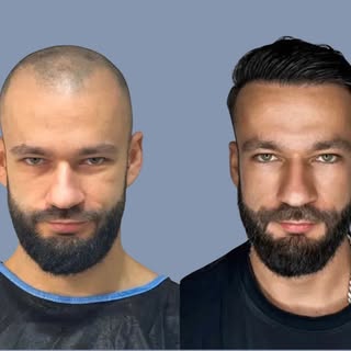 3500 grafts, harvested and placed individually. Follicular unit extraction, also known as FUE, shown