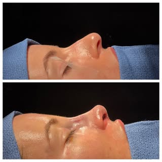 Primary rhinoplasty, photographed on the table at the end of the case.

She wanted a lower bridge in