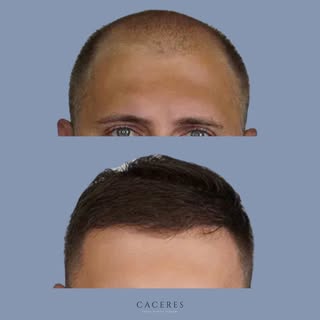 3,500 grafts. One year later.

The difference is in the coverage, but also in what you do not notice