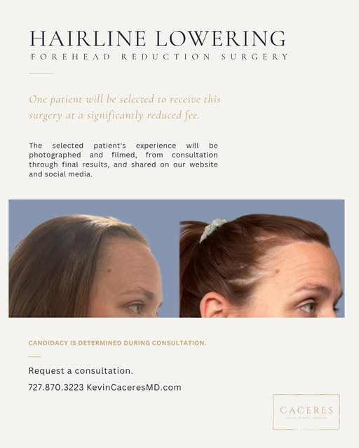 We’re looking for one person.

Hairline lowering, also called forehead reduction, is a surgical proc