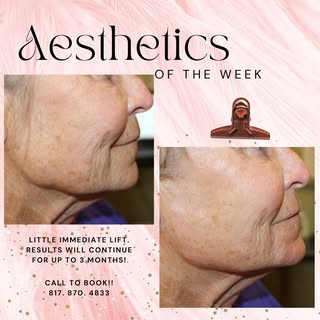⭐ Aesthetic injectable highlights

⭐ Biostimulator treatment to help turn back the hands of time.
 ◽