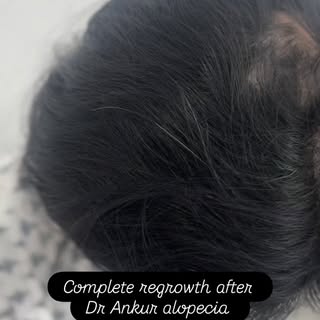 Now treat your alopecia completely with AIIMS Dr Ankur Lal MD without steroid and side effects.
At S