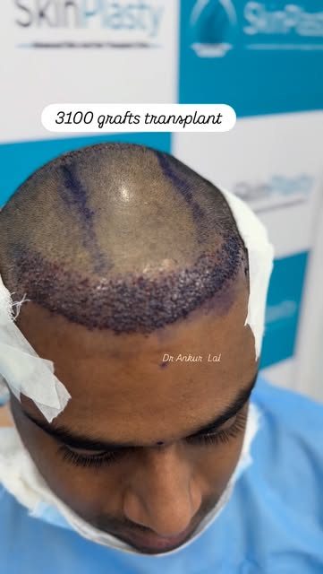 At Skinplasty, we provide customized solutions for hair loss using evidence-based treatments includi