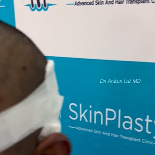 Natural hair restoration with advanced hair transplant techniques by  Skinplasty￼.
Achieve natural h