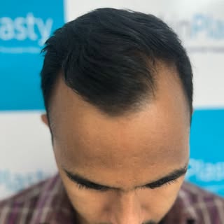 Struggling with hair loss? 
Dr. Ankur at Skinplasty Clinic, Noida offers the best FUE & DHI hair tra