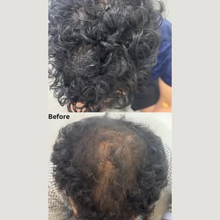 At Skinplasty Clinic, Noida, Dr. Ankur Lal, MD Dermatology helps patients with hair fall, hair thinn