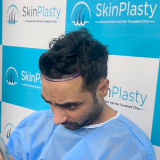This hairline was meticulously designed to complement the patient’s facial features, age, and future