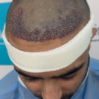 A new hairline. A new level of confidence

Every successful hair transplant starts with careful plan