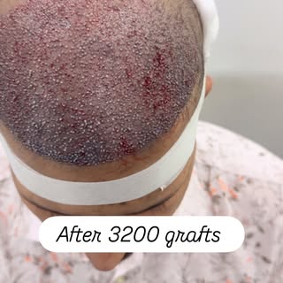 3,200 Grafts | FUE Hair Transplant | Natural Hairline Transformation

Another successful 3,200-graft