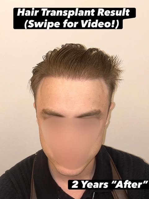 Hair Transplant Result! By Dr Blake Bloxham (Bloxham Medical) 

Patients often tell me they only see