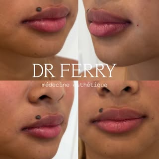 • Résultats juste après injection de 1 ml d’acide hyaluronique 

📸

• Ma patiente souhaitait sensua