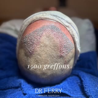 ▪️Greffe capillaire – 1500 greffons | Méthode FUE Saphir

Correction ciblée des golfes temporaux ave