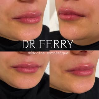 💋 Avant / Après – Injection d’acide hyaluronique des lèvres 💋

🦋 Redessiner la lèvre supérieure a