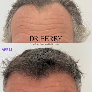 🧔🏻 Avant/Après GREFFE CAPILLAIRE  de type FUE 
  Résultat à + 4 mois 🖤

• 1500 greffons ont été p