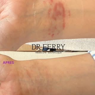 ▪️ TRAITEMENT DES CICATRICES PAR LASER▪️

Résultat avant/après 4 séances de laser fractionné pour su