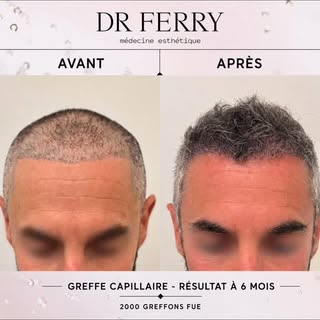 🫶🏻 GREFFE CAPILLAIRE -  FUE - 2000 greffons 

Résultats 6 mois après l’intervention 

Notre patien
