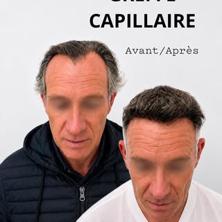 ▪️Restaurer une ligne capillaire forte mais aussi naturelle pour redonner de la masculinité au visag