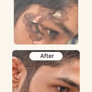 ✨ Before → After
These are the images showing results of one of our patients for post accidental sca
